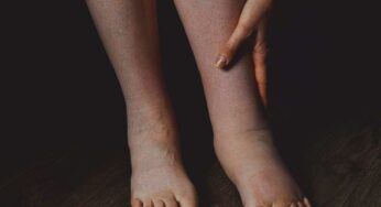 Se noti questo segno sulle gambe potresti soffrire di una malattia molto grave senza saperlo