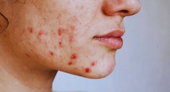 In estate record di infezioni cutanee: attenzione a questo dettaglio ‘innocuo’ sulla pelle